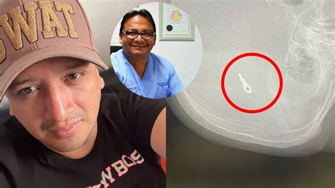 Tarapoto Paciente Terminó Con Muerte Cerebral Tras Operación De Rinoplastia Amigos Denuncian