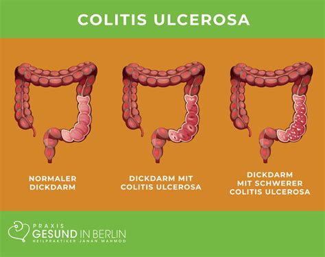 Colitis Ulcerosa Naturheilpraxis Gesund In Berlin