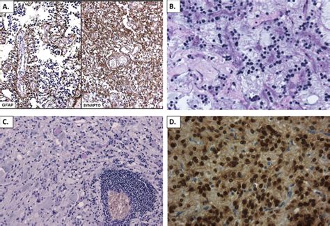 Pathologic Features Of Glioneuronal Tumors A Histopathology Of