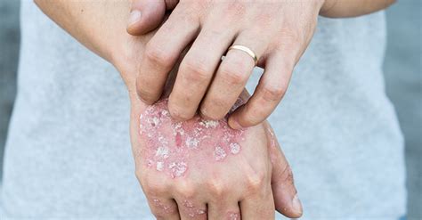 Eczema