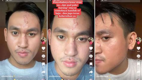 Foto Viral Curhatan Pria Kena Herpes Zoster Penyakit Apa Itu