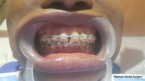 Ceramic Braces 6 001 Platinum Dental Surgery