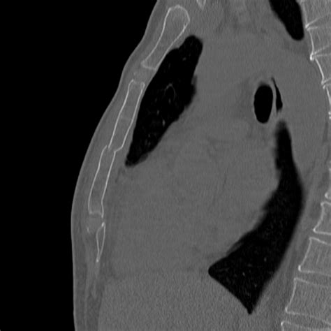 Radiopaedia case Sternum fracture id: 15242 study: 15084 - NC Commons