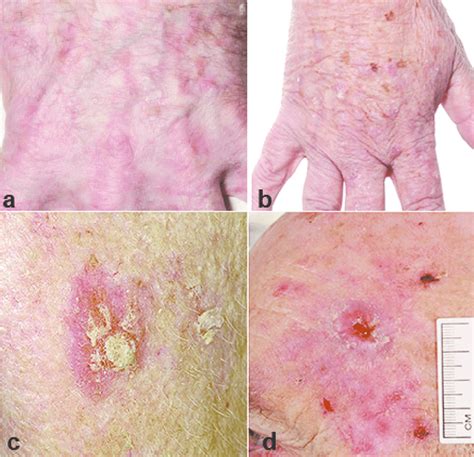 Examples Of The Spectrum Of Keratotic Lesions Encountered In The Renal