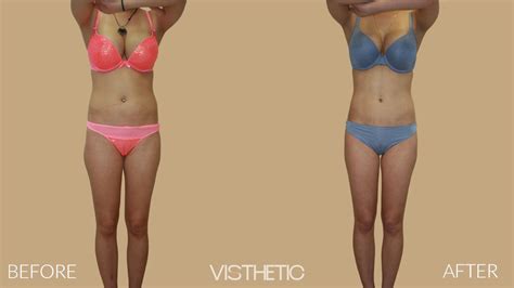 Brazilian Butt Lift Gallery - Visthetic Med Spa