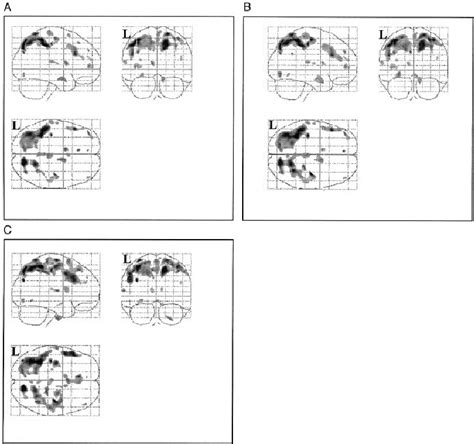 Reduced Grey Matter Volume With Increasing Age In Downs Syndrome