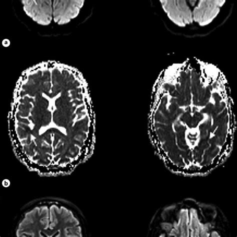 Axial Section Of Mri Brain A Dwi And B Adc Sequence Demonstrating