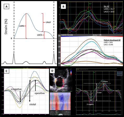 Left Atrial Strain A R Wave Triggering B Strain Curve Demonstrating