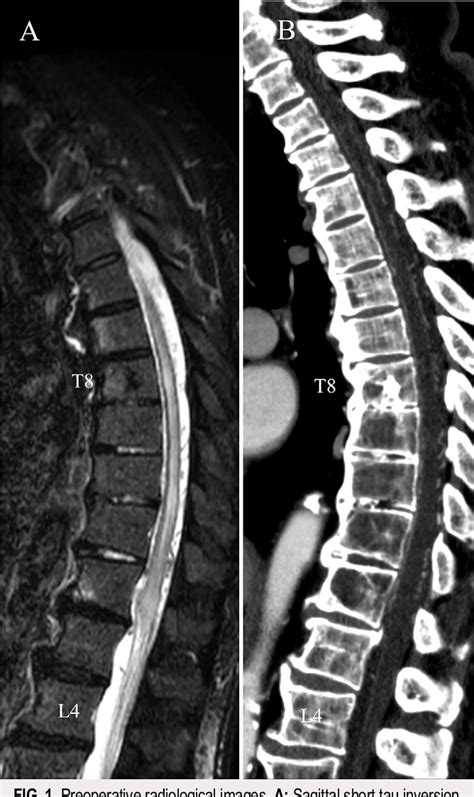 Figure 1 From Interactive Spinal Computed Tomography Angiographyguided