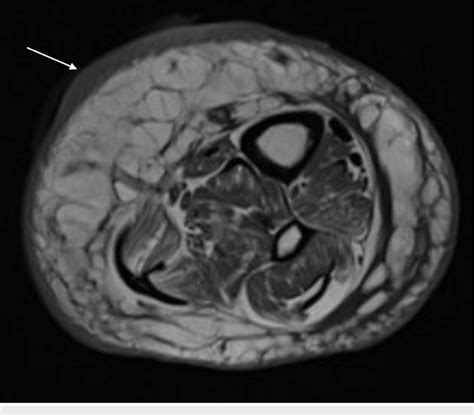 MRI showing wound (white arrow) medially in the distal calf with ...