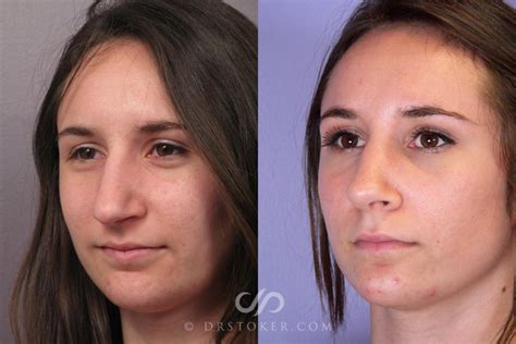 Deviated Septum Nose Job Before And After Hildegard Marks