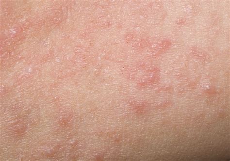 Contact Dermatitis Overview And More