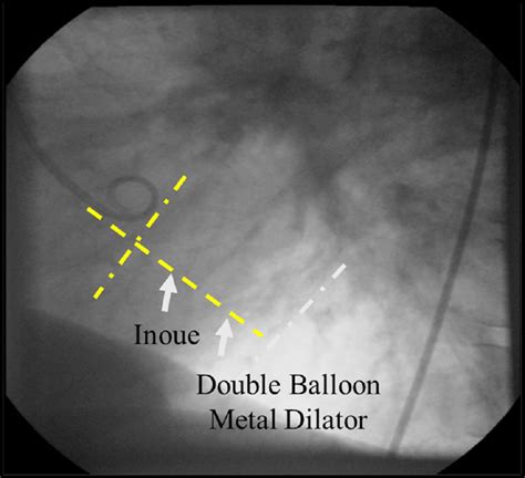 More Selective Site Of Transseptal Puncture According Procedure To Be