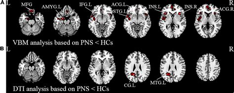 Frontiers Meta Analysis Of Structural And Functional Brain