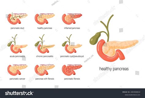 Pancreas Diseases Concept Set Anatomical Icons Stock Vector (Royalty ...