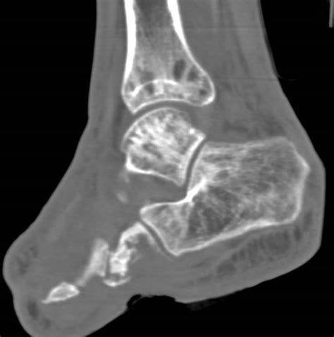 Osteomyelitis Involves The Calcaneus And The Cuboid Musculoskeletal