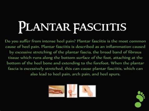 Plantar fasciitis information & treatment | PPT