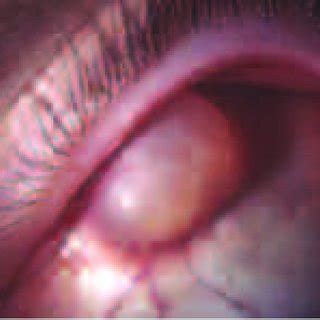 Biomicroscopy: conjunctival cyst. | Download Scientific Diagram