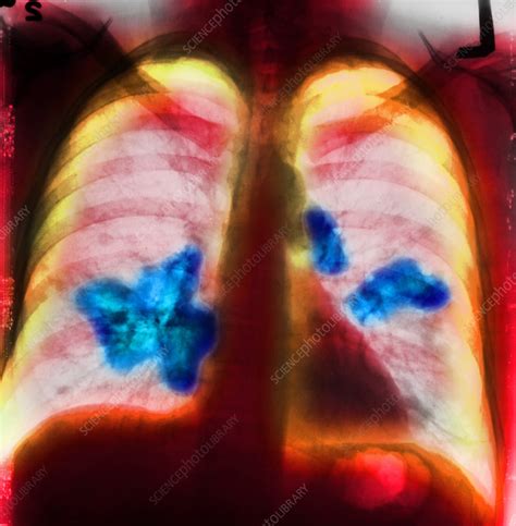 Lung Cancer Chest X Ray Stock Image C Science Photo Library