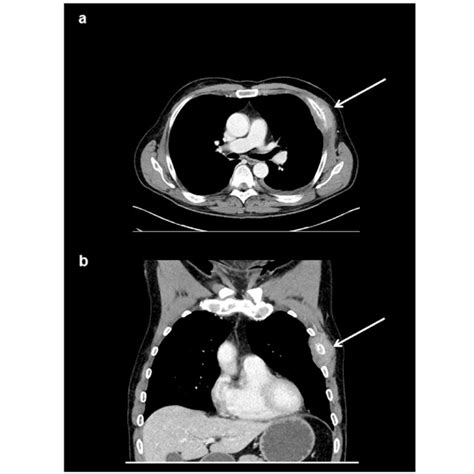 Myeloid Sarcoma Of The Chest Wall In A Male Patient With Known Acute