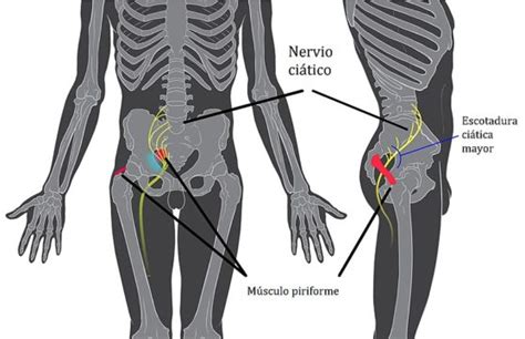 Ci Tica Tratada Con Fisioterapia Cl Nica Fuensalud