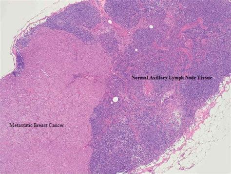 Axillary Lymph Node Cancer