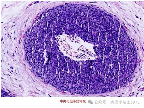 病理规培图库 乳腺导管原位癌 Medscicn