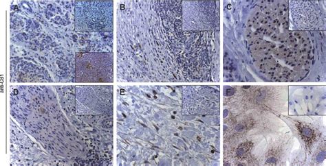 Cannabinoid Receptor 1 In Human Chronic Pancreatitis Tissues CB1