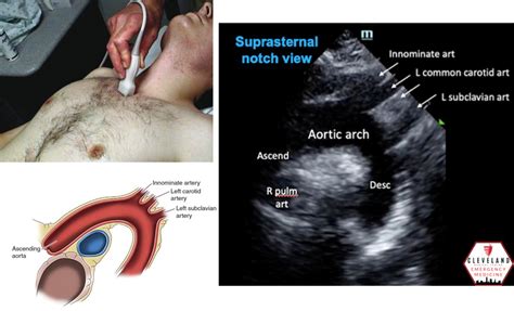 Suprasternal Notch