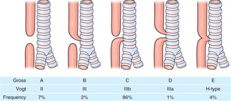 Esophageal Atresia Types