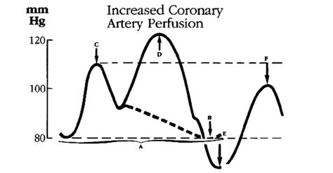 Intraaortic Balloon Pump Therapy Iabp Diagram Quizlet