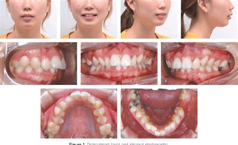 Figure 1 From Treatment Of A Class Ii Deep Bite Malocclusion Using Orthodontic Mini Implants