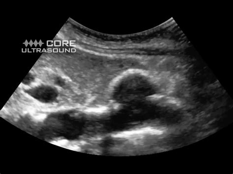 Aortic Aneurysm Ultrasound