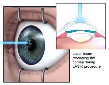 Laser Eye Surgery LASIK RNpedia