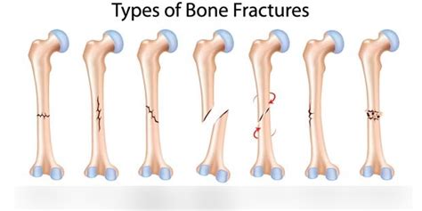 Fractures Part 1 Diagram Quizlet