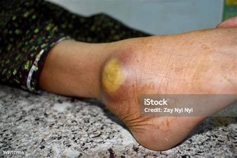 Abses Besar Dan Selulitis Di Kaki Pasien Pria Tua Burma Asia Foto Stok