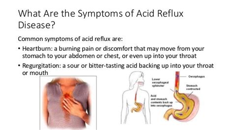 How To Treat Acid Reflux And Prevent Heartburn And Chest Pain Acid Re