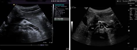 Nutcracker Syndrome Ultrasound