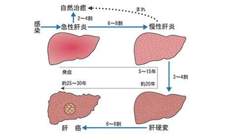 肝炎的症状图片 肝炎图片大全 肝炎 39疾病百科