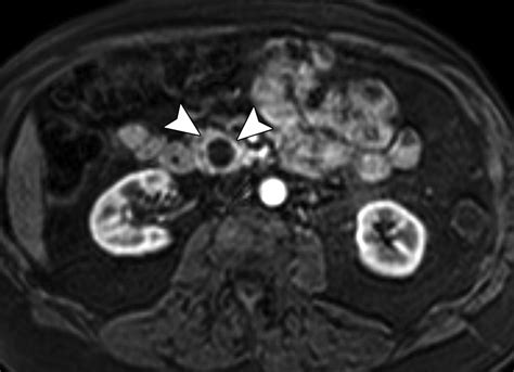 Mr Imaging Of Cystic Lesions Of The Pancreas Radiographics