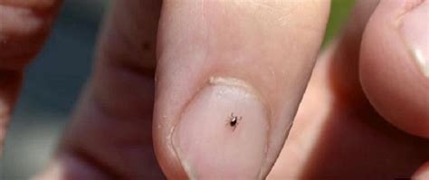 Finding Deer Ticks on Yourself and Family? Try These Deer Tick Bite Prevention Tips