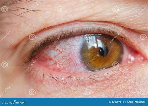 Closeup Irritated Infected Red Bloodshot Eyes Conjunctivitis Stock