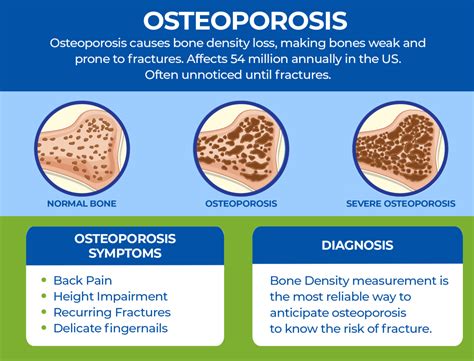 Understanding difference b/w Osteoarthritis vs Osteoporosis