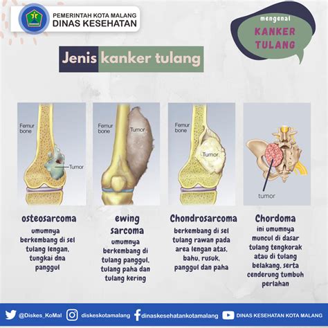 Mengenal Kanker Tulang Untuk Meningkatkan Kewaspadaan Dinas Kesehatan