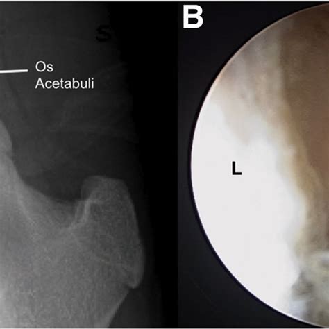 (PDF) Arthroscopic Fixation of Os Acetabuli and Labral Repair: Suture ...