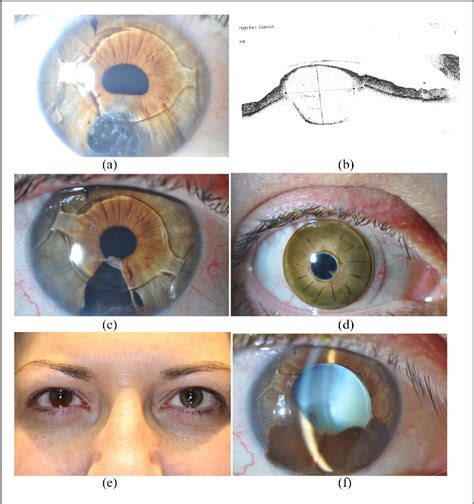 Figure 1 From Iris And Ciliary Body Cysts And Phakic Intraocular Lenses