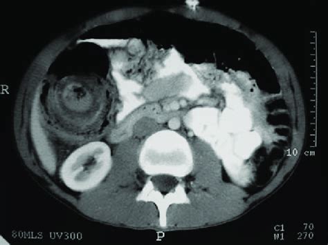 Small Bowel Intussusception Download Scientific Diagram