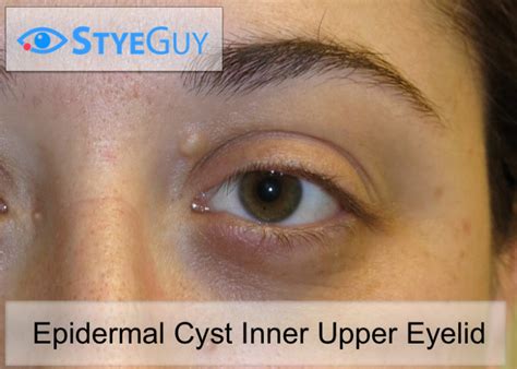 Epidermal Cyst Styeguy