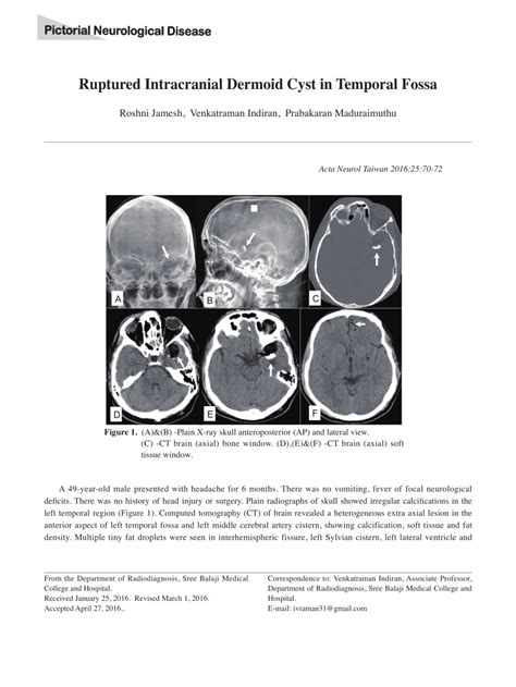 Pdf Ruptured Intracranial Dermoid Cyst In Temporal Fossa