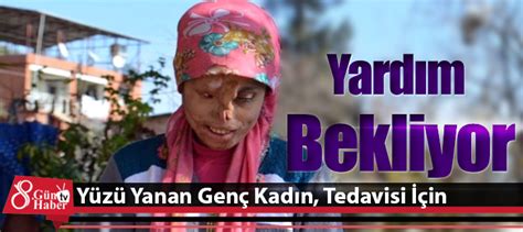 Yüzü Yanan Genç Kadın Tedavisi İçin Yardım Bekliyor Kırıkhan Hatay